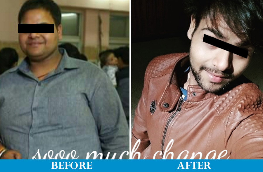 After Bariatric surgery 3