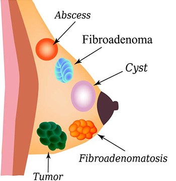 Fibrocystic Breast DiseaseTreatment in Faridabad 