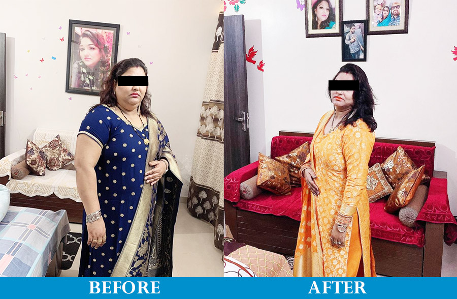 Sangeeta after Bariatric surgery 1