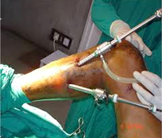 Subfascial Endoscopic Perforator surgery 
