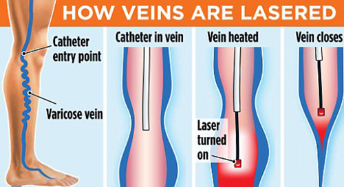 varicose vein laser treatment in faridabad