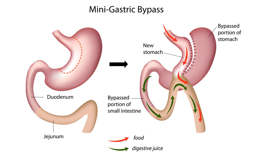 Mini gastric bypass