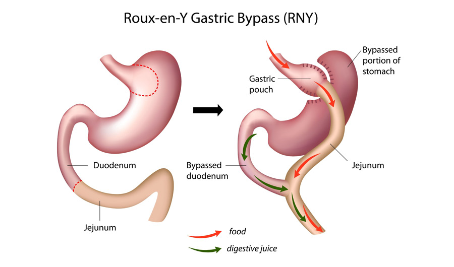 Roux en Y Gastric Bypass RYGB